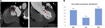 Risk factors and clinical effects of subclinical leaflet thrombosis after transcatheter aortic valve replacement